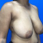 Breast Reduction Before & After Patient #5693