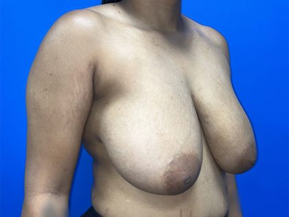 Breast Reduction Before & After Patient #5693