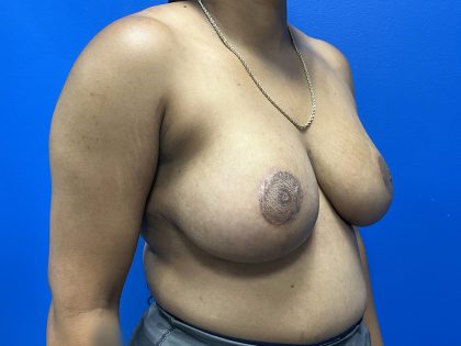 Breast Reduction Before & After Patient #5693