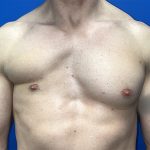 Poland Syndrome Before & After Patient #5709