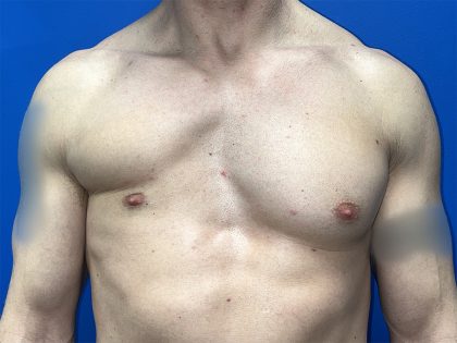 Poland Syndrome Before & After Patient #5709