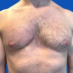 Poland Syndrome Before & After Patient #5709