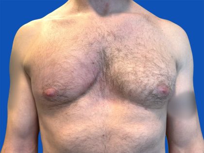 Poland Syndrome Before & After Patient #5709