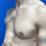 Poland Syndrome Before & After Patient #5709