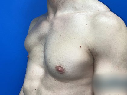 Poland Syndrome Before & After Patient #5709