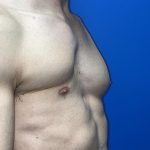 Poland Syndrome Before & After Patient #5709
