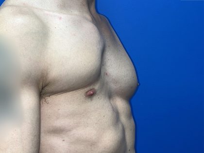 Poland Syndrome Before & After Patient #5709