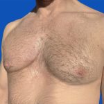 Poland Syndrome Before & After Patient #5709