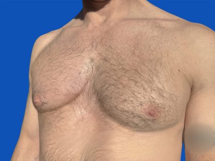Poland Syndrome Before & After Patient #5709