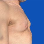 Poland Syndrome Before & After Patient #5709