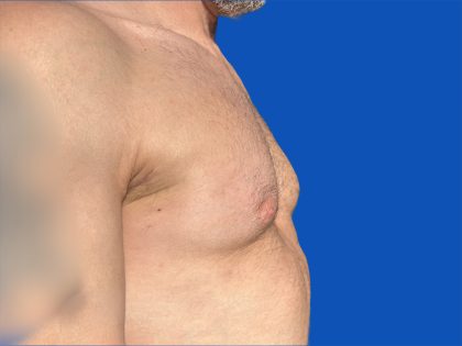 Poland Syndrome Before & After Patient #5709