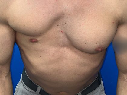 Poland Syndrome Before & After Patient #5709