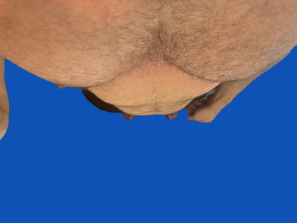 Poland Syndrome Before & After Patient #5709