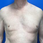 Poland Syndrome Before & After Patient #5758