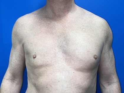Poland Syndrome Before & After Patient #5758