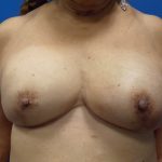 Direct to Implant Breast Reconstruction Before & After Patient #5720