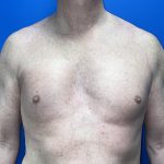 Poland Syndrome Before & After Patient #5758