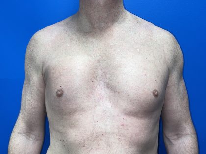 Poland Syndrome Before & After Patient #5758