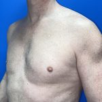 Poland Syndrome Before & After Patient #5758