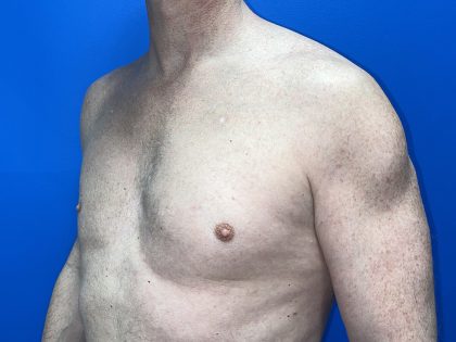 Poland Syndrome Before & After Patient #5758