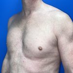 Poland Syndrome Before & After Patient #5758