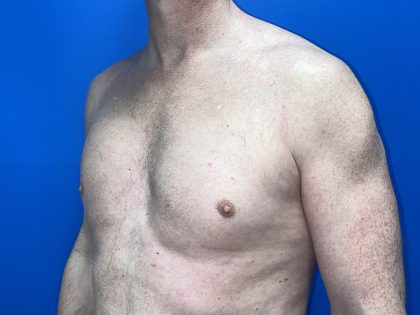 Poland Syndrome Before & After Patient #5758