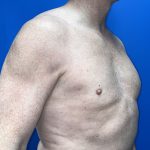 Poland Syndrome Before & After Patient #5758