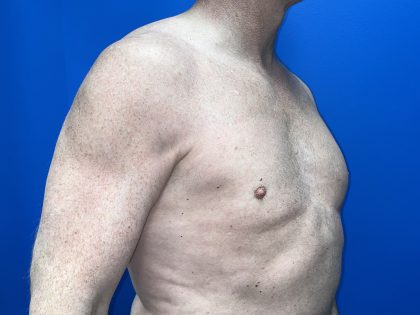 Poland Syndrome Before & After Patient #5758
