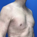 Poland Syndrome Before & After Patient #5758