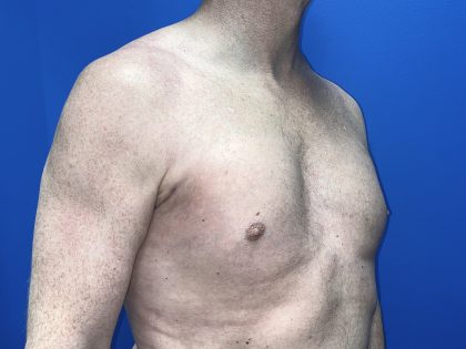 Poland Syndrome Before & After Patient #5758