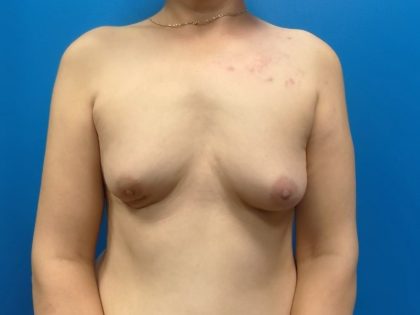Direct to Implant Breast Reconstruction Before & After Patient #5737